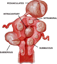 Location of uterine fibroids