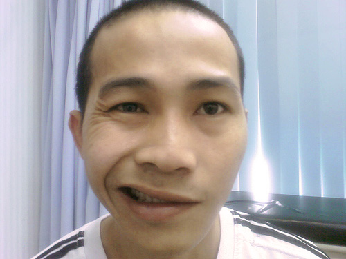 Patient had left sided facial nerve paralysis—a classic symptom of Bell's Palsy