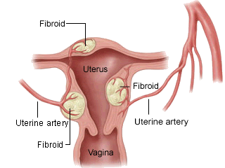 Acupuncture Treatment for Uterine Fibroids